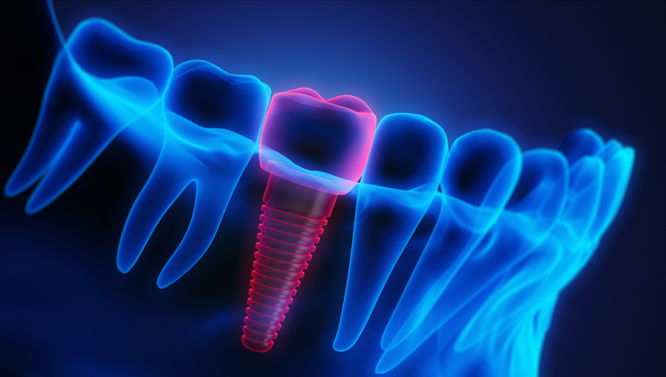 Close-up of a dental implant with crown in the lower jaw against a dark background - X Ray 3D illustration